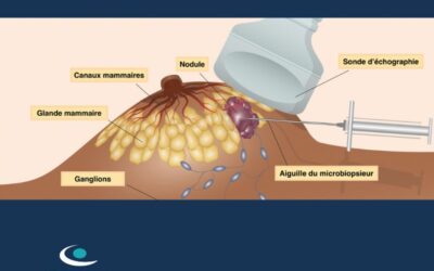 Microbiopsie sous Échographie : Une Avancée en Imagerie Médicale